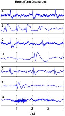 Distinguishing Epileptiform Discharges From Normal Electroencephalograms Using Scale-Dependent Lyapunov Exponent